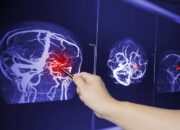 Bagaimana Otak Menyesuaikan Diri Setelah Cedera