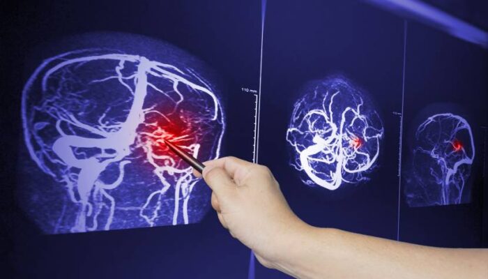 Bagaimana Otak Menyesuaikan Diri Setelah Cedera
