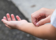 Kenapa Kita Selalu Ingin Garuk Saat Gatal Menyerang