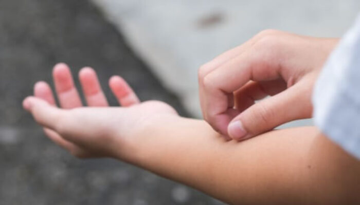 Kenapa Kita Selalu Ingin Garuk Saat Gatal Menyerang