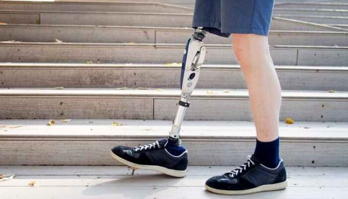 Mengapa Kita Bisa Merasa Nyeri Hantu Setelah Amputasi