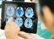 Kanker Otak Paling Mematikan Bisa Mati Hanya Dengan Pil