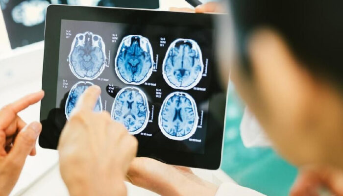 Kanker Otak Paling Mematikan Bisa Mati Hanya Dengan Pil